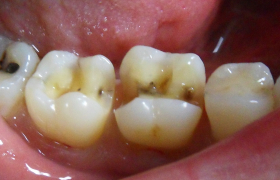  Dr Pascal Blanc Dentiste à Meylan Inlay-onlay céramiques